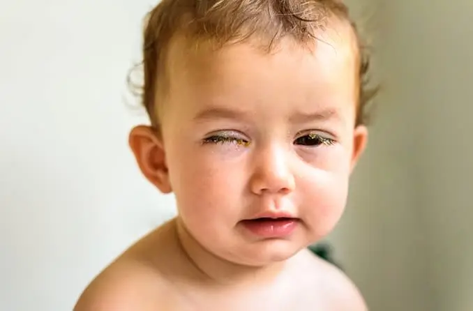 What is Conjunctivitis?